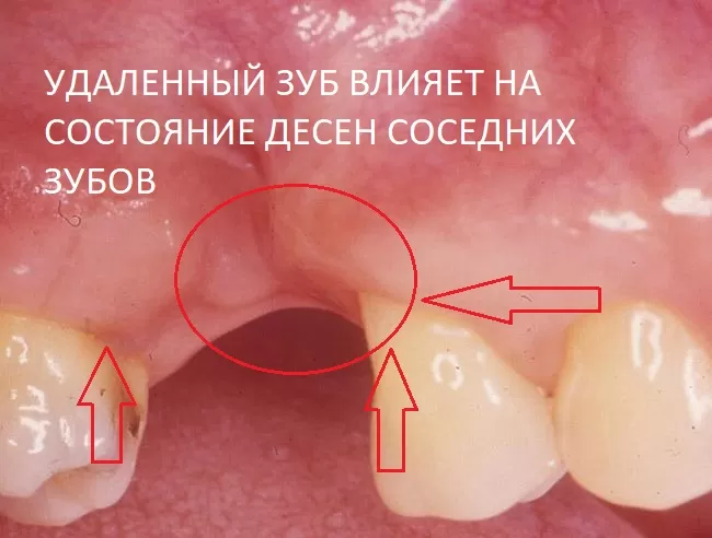 Деструкция альвеолярного отростка при удалении зуба, которая со временем переходит на соседний связочный аппарат соседних зубов